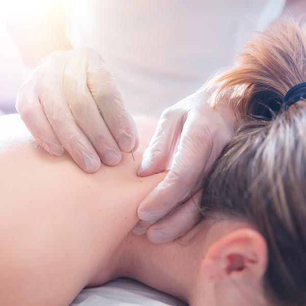 Physiotherapist doing acupuncture to a young woman on her back