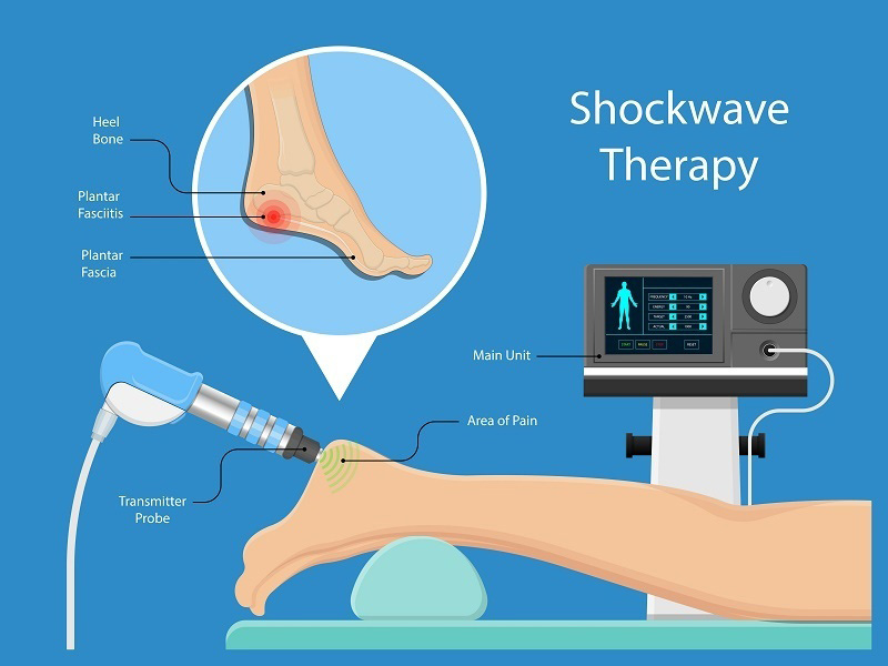 shockwave therapy